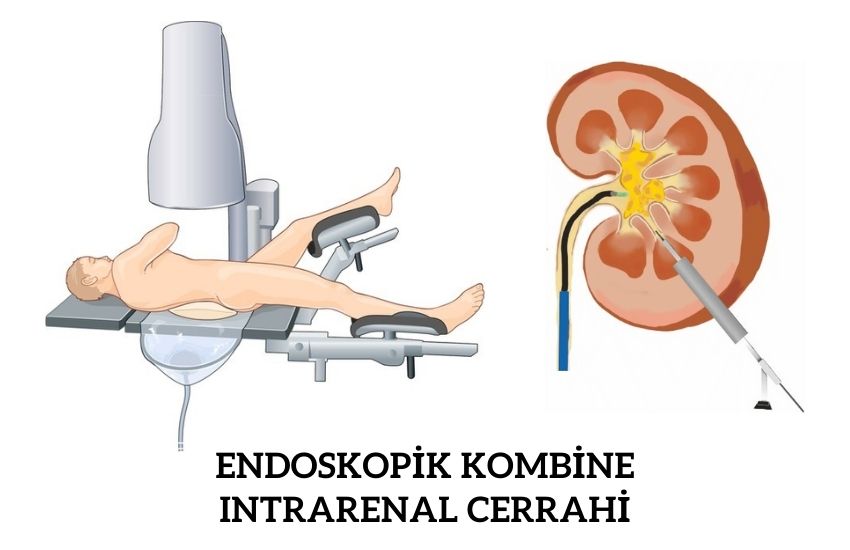 Endoskopik Kombine Intrarenal Cerrahi (ECIRS)